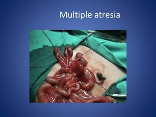 Multiple atresia
 