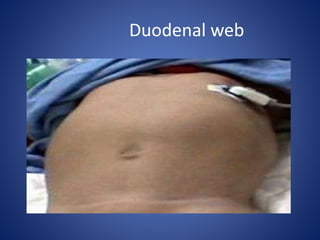 Duodenal web
 