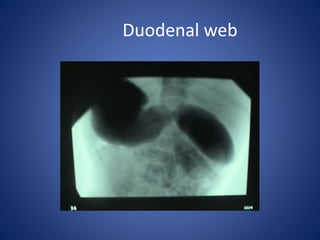 Duodenal web
 