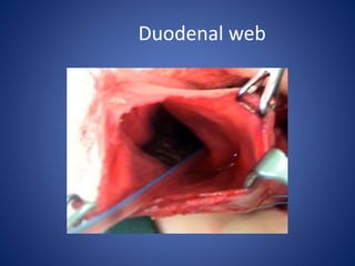 Duodenal web
 