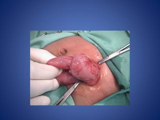 Intussusception
 
