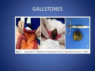 GALLSTONES
 