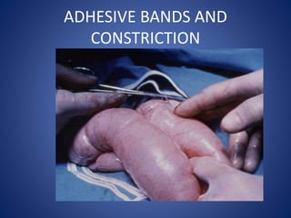 ADHESIVE BANDS AND
CONSTRICTION
 