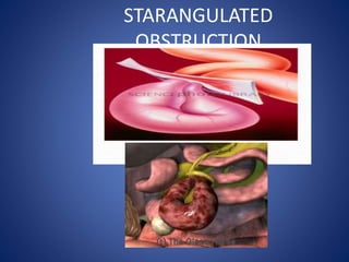 STARANGULATED
OBSTRUCTION
 