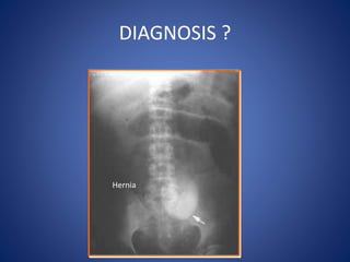 DIAGNOSIS ?
Hernia
 