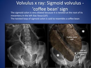 Volvulus x ray: Sigmoid volvulus -
'coffee bean' sign
The sigmoid colon is very dilated because it is twisted at the root of its
mesentery in the left iliac fossa (LIF)
The twisted loop of sigmoid colon is said to resemble a coffee bean
 
