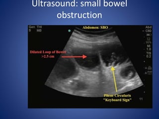 Ultrasound: small bowel
obstruction
 