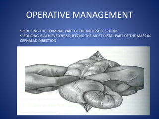 OPERATIVE MANAGEMENT
•REDUCING THE TERMINAL PART OF THE INTUSSUSCEPTION :
•REDUCING IS ACHIEVED BY SQUEEZING THE MOST DISTAL PART OF THE MASS IN
CEPHALAD DIRECTION
 