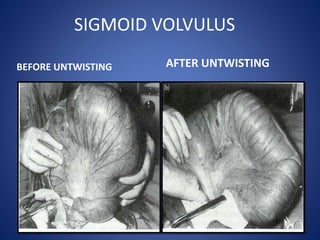 SIGMOID VOLVULUS
BEFORE UNTWISTING AFTER UNTWISTING
 