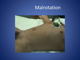 Malrotation
 