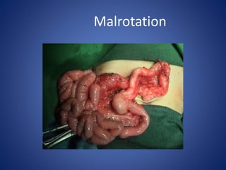 Malrotation
 