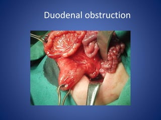 Duodenal obstruction
 