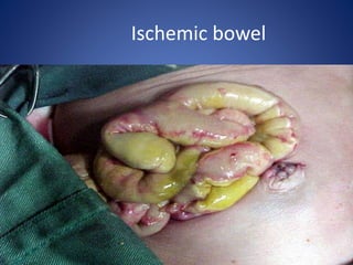 Ischemic bowel
 