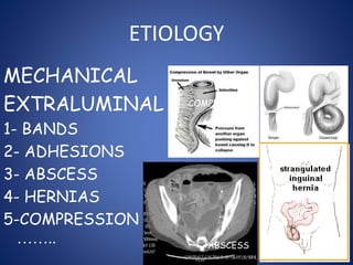 ETIOLOGY
MECHANICAL
EXTRALUMINAL
1- BANDS
2- ADHESIONS
3- ABSCESS
4- HERNIAS
5-COMPRESSION
……..
BANDS
ABSCESS
COMPRESSION
HERNIA
 