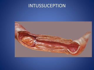 INTUSSUCEPTION
 