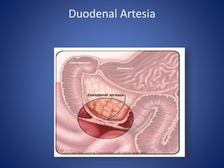Duodenal Artesia
 