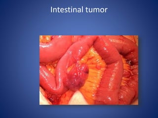Intestinal tumor
 