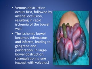 .
• Venous obstruction
occurs first, followed by
arterial occlusion,
resulting in rapid
ischemia of the bowel
wall.
• The ischemic bowel
becomes edematous
and infarcts, leading to
gangrene and
perforation. In large-
bowel obstruction,
strangulation is rare
(except with volvulus)
 