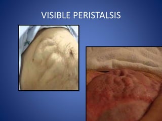 VISIBLE PERISTALSIS
 