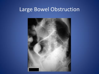 Large Bowel Obstruction
 
