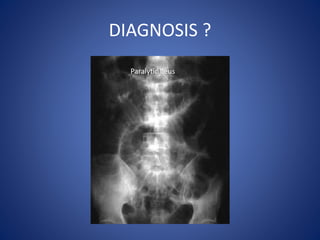 DIAGNOSIS ?
Paralytic Ileus
 