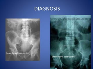 DIAGNOSIS
Small bowel obstruction
Large bowel obstruction
 