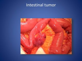 Intestinal tumor
 