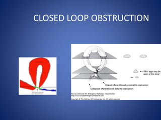 CLOSED LOOP OBSTRUCTION
 