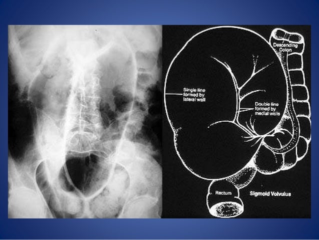 Intestinal obstruction