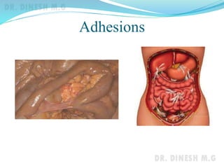 Intestinal Obstruction | PPTX