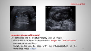 Intussusception on ultrasound
(A) Transverse and (B) longitudinal gray-scale US images
- characteristic of intussusception with a target and “pseudokidney”
appearance, respectively.
- Lymph nodes can be seen with the intussusceptum on the
transverse image (arrow) 105
Intussusception
 