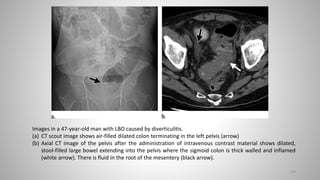109
Images in a 47-year-old man with LBO caused by diverticulitis.
(a) CT scout image shows air-filled dilated colon terminating in the left pelvis (arrow)
(b) Axial CT image of the pelvis after the administration of intravenous contrast material shows dilated,
stool-filled large bowel extending into the pelvis where the sigmoid colon is thick walled and inflamed
(white arrow). There is fluid in the root of the mesentery (black arrow).
 