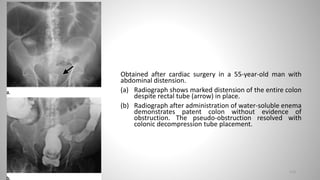 Obtained after cardiac surgery in a 55-year-old man with
abdominal distension.
(a) Radiograph shows marked distension of the entire colon
despite rectal tube (arrow) in place.
(b) Radiograph after administration of water-soluble enema
demonstrates patent colon without evidence of
obstruction. The pseudo-obstruction resolved with
colonic decompression tube placement.
113
 