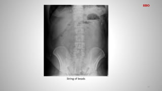 17
String of beads
SBO
 