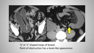 26
'U' or 'C' shaped loops of bowel.
Point of obstruction has a beak-like appearance
 