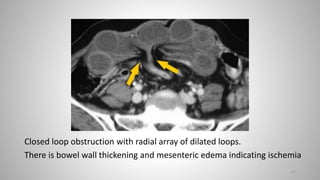 Closed loop obstruction with radial array of dilated loops.
There is bowel wall thickening and mesenteric edema indicating ischemia
27
 