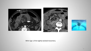 28
Whirl sign: of the tightly twisted mesentery
 