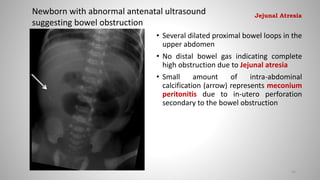 • Several dilated proximal bowel loops in the
upper abdomen
• No distal bowel gas indicating complete
high obstruction due to Jejunal atresia
• Small amount of intra-abdominal
calcification (arrow) represents meconium
peritonitis due to in-utero perforation
secondary to the bowel obstruction
Newborn with abnormal antenatal ultrasound
suggesting bowel obstruction
45
Jejunal Atresia
 