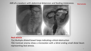 Ileal atresia
7(a) Multiple dilated bowel loops indicating a distal obstruction
7(b) Contrast enema show a microcolon with a blind ending small distal ileum
representing ileal atresia.
AXR of a newborn with abdominal distension and feeding intolerance.
49
Ileal atresia
 