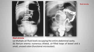 Ileal atresia
(a) Multiple air-fluid levels occupying the entire abdominal cavity.
(b) Barium enema: numerous dilated, air-filled loops of bowel and a
small, unused colon (functional microcolon).
51
Ileal atresia
 