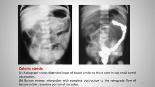 Colonic atresia
(a) Radiograph shows distended loops of bowel similar to those seen in low small bowel
obstruction.
(b) Barium enema: microcolon with complete obstruction to the retrograde flow of
barium in the transverse portion of the colon.
52
 