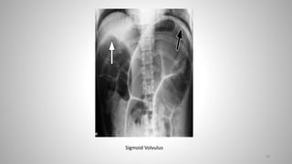 58
Sigmoid Volvulus
 