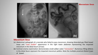 Meconium ileus
(a) Abdominal radiograph of a neonate who failed to pass meconium, showing distended gas filled bowel
loops and "soap bubble" appearance in the right lower abdomen representing the impacted
meconium in the distal ileum (arrow).
(b) Contrast enema examination demonstrates small-caliber colon "microcolon". Numerous filling defects
in the distal ileum represent the impacted meconium pellets. Note the multiple proximal dilated loops
of bowel.
62
Meconium ileus
 