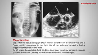 Meconium ileus
(a) Abdominal scout radiograph shows marked distention of the small bowel and a
“soap bubble” appearance in the right side of the abdomen (arrows), a finding
suggestive of mottled air and feces.
(b) US image shows dilated, fluid-filled intestinal loops containing echogenic material
(calcified meconium) (arrows). Associated ileal atresia was seen at surgery. 63
Meconium ileus
 
