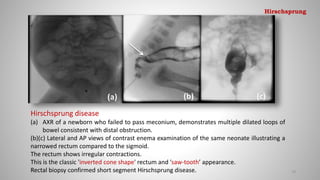 Hirschsprung disease
(a) AXR of a newborn who failed to pass meconium, demonstrates multiple dilated loops of
bowel consistent with distal obstruction.
(b)(c) Lateral and AP views of contrast enema examination of the same neonate illustrating a
narrowed rectum compared to the sigmoid.
The rectum shows irregular contractions.
This is the classic 'inverted cone shape' rectum and 'saw-tooth’ appearance.
Rectal biopsy confirmed short segment Hirschsprung disease. 78
Hirschsprung
 