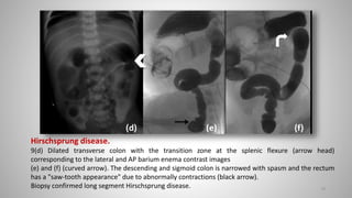 Hirschsprung disease.
9(d) Dilated transverse colon with the transition zone at the splenic flexure (arrow head)
corresponding to the lateral and AP barium enema contrast images
(e) and (f) (curved arrow). The descending and sigmoid colon is narrowed with spasm and the rectum
has a "saw-tooth appearance" due to abnormally contractions (black arrow).
Biopsy confirmed long segment Hirschsprung disease. 79
 