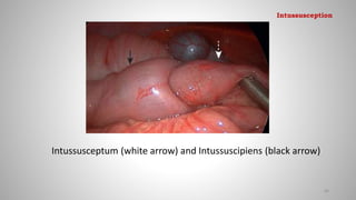 Intussusceptum (white arrow) and Intussuscipiens (black arrow)
84
Intussusception
 