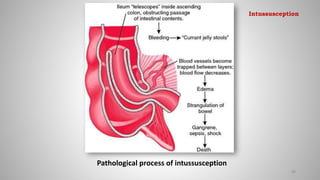 Pathological process of intussusception
89
Intussusception
 