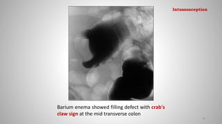 Barium enema showed filling defect with crab's
claw sign at the mid transverse colon
96
Intussusception
 