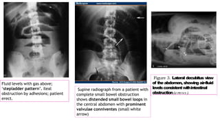 Intestinal obstruction | PPTX